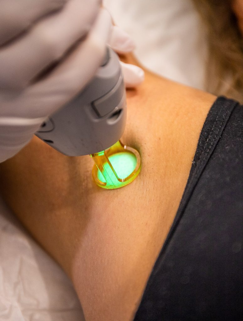 Hair laser removal under an armpit