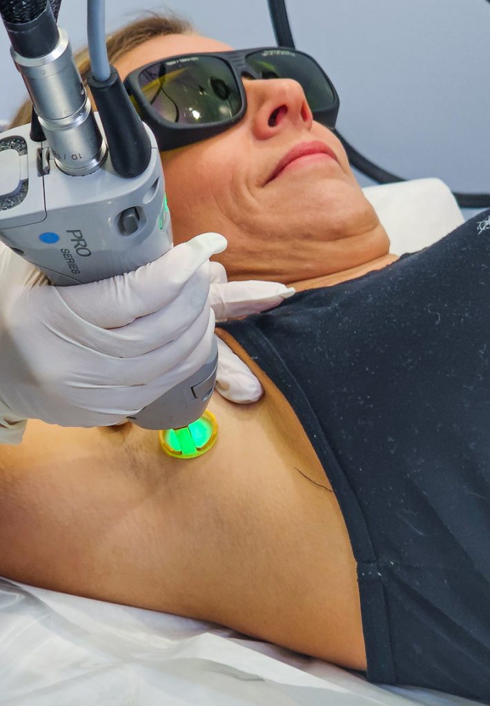 Lady getting hair laser treatment under her armpits